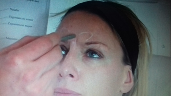 Botox for '11' lines