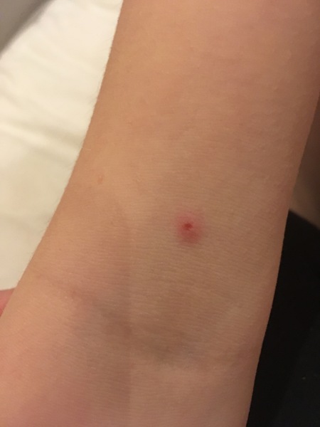Is this chicken pox or AIBU/neurotic
