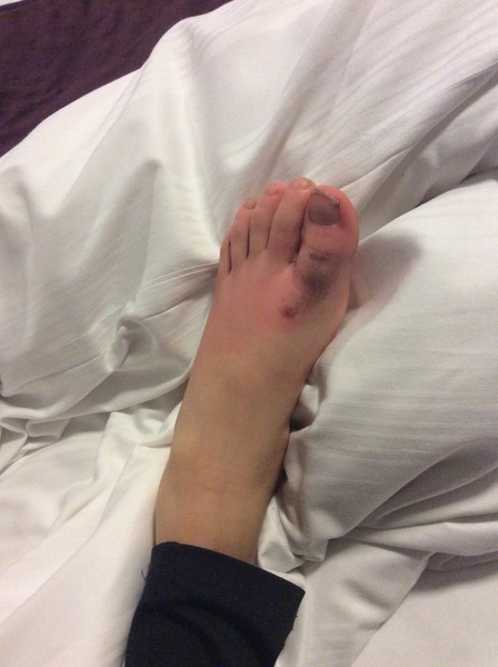 My child had a horrific accident on an escalator