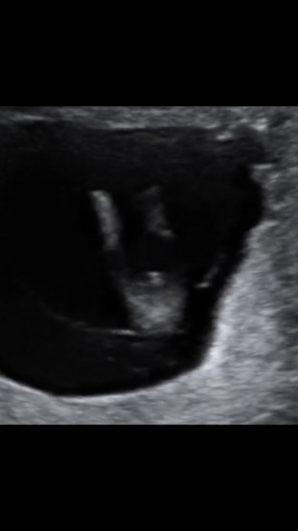 August 2018 #3 - booking appointments and 12 week scans!