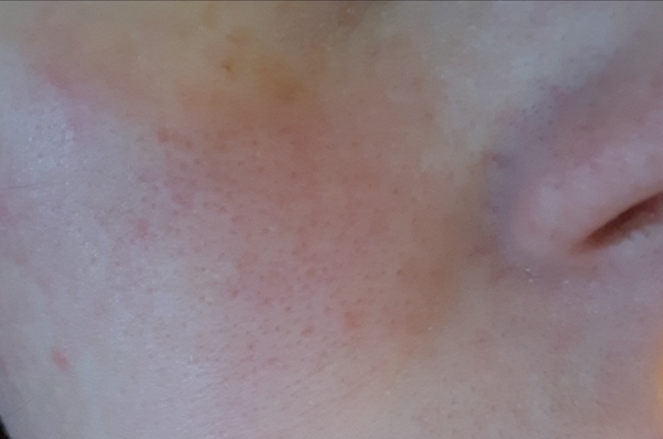 Large pores