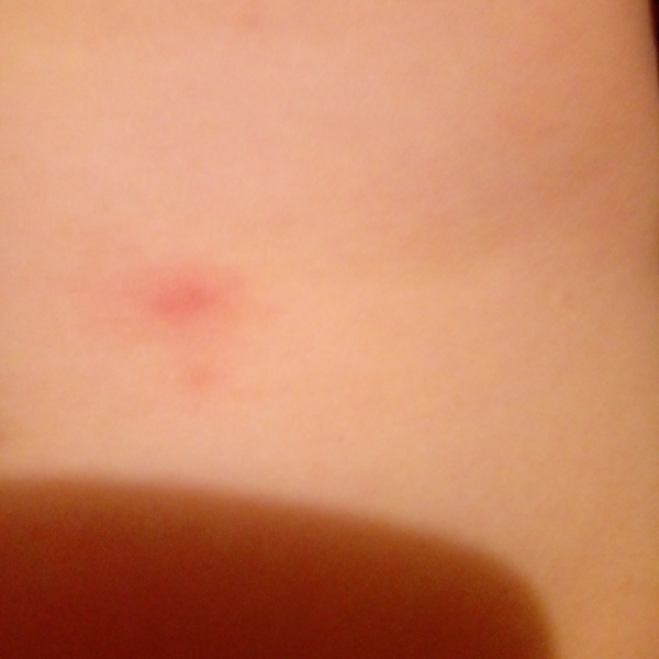 Chicken pox or not?