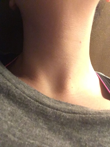 What can I do about this? (Gross neck pic)