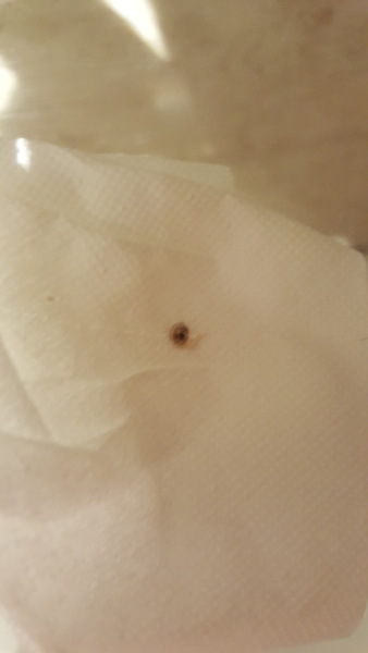 Does anyone want to see a bazooka'd verrucca?