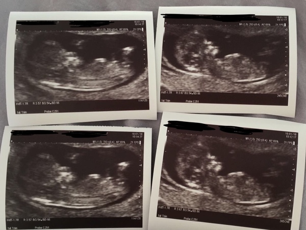 12 week scan today, is this the nub?!