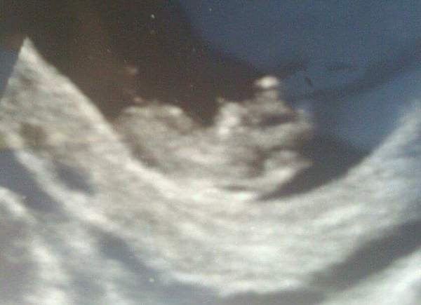 8 week scan - what will we see?
