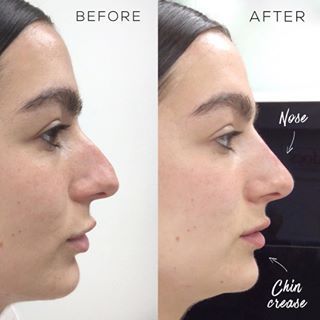 Rhinoplasty Surgeons