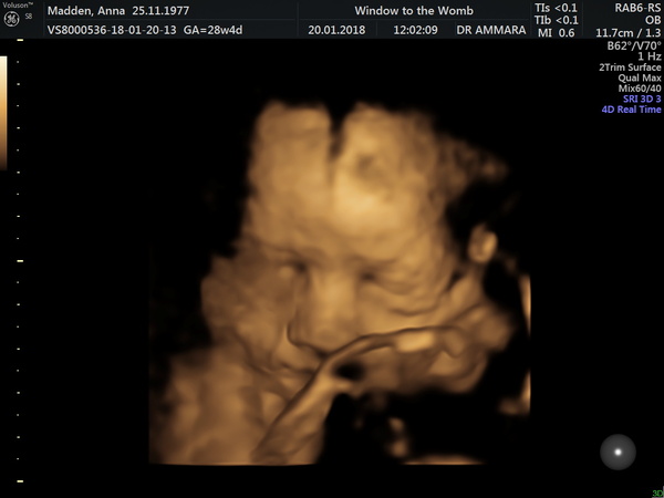 Pregnancies due April 2018
