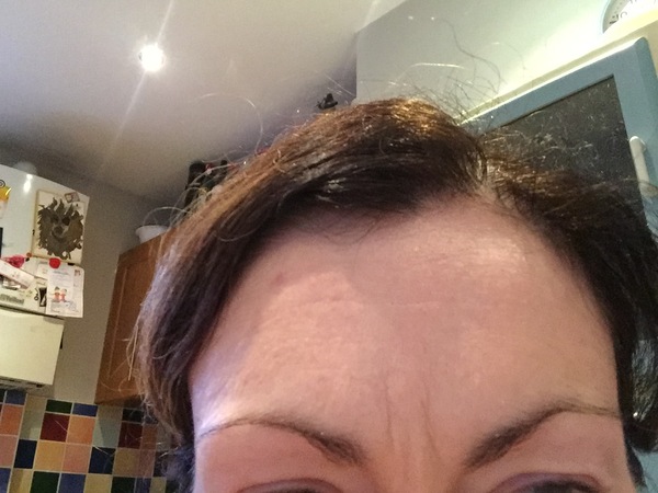 Botox for '11' lines