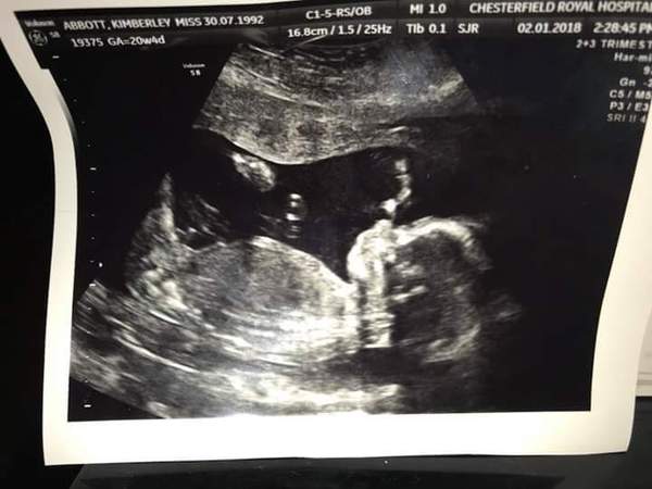 May 2018 thread 3, 12 week scans and heading towards the 2nd trimester