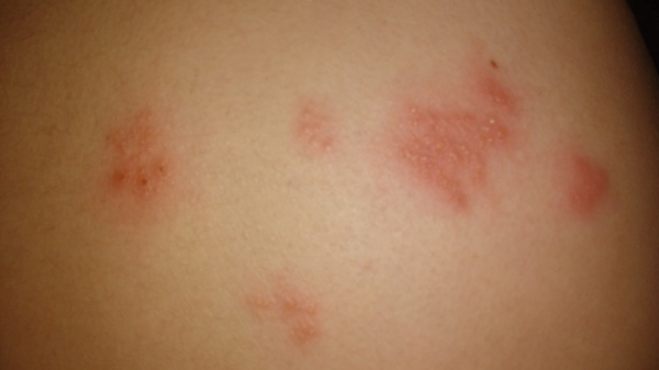 rash wtf is it?