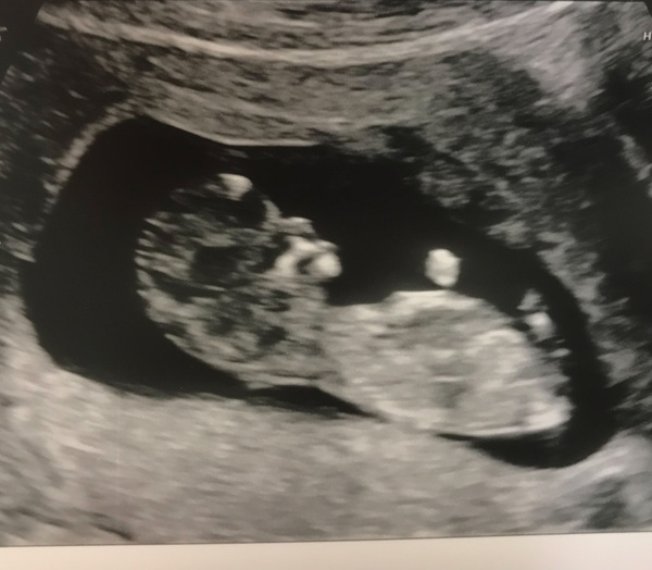 Boy or Girl? Nub theory? What do you think ladies!