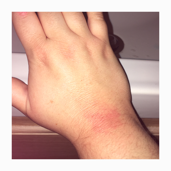 What is this rash?!