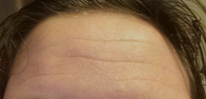 Deep, staying, forehead wrinkles