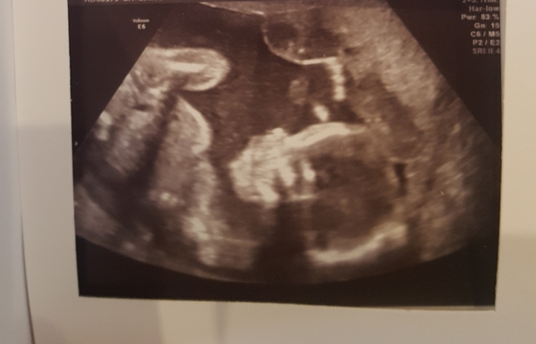 Posifrickentive into 2018 - thread 20 for those pregnant after mc