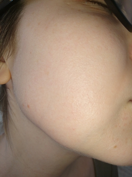 Bumps covering face