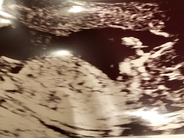 NT results and nasal bone