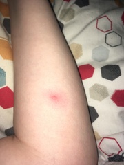 Is this a spider / insect bite? (Pics included)