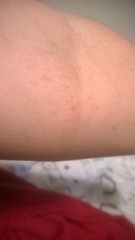 HA and rash on my elbow.