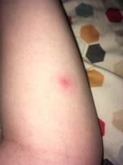 Is this a spider / insect bite? (Pics included)