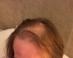Hair loss support thread