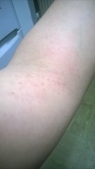 HA and rash on my elbow.