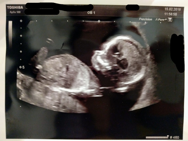 Boy or girl? Nub theory