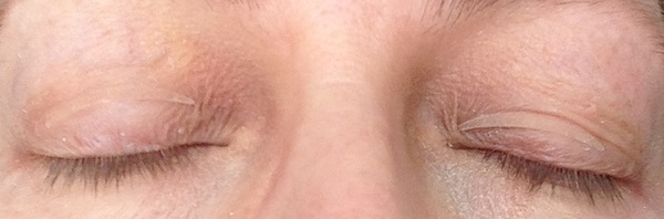 Hooded eyes, what are the options?