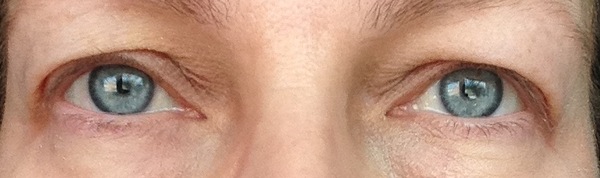 Hooded eyes, what are the options?