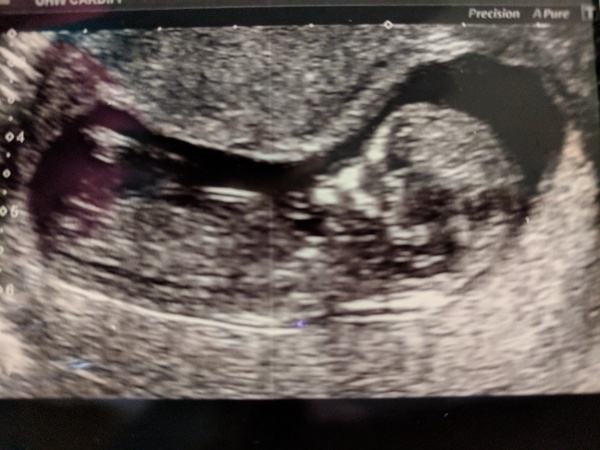 September 2018: #3! Early scans and booking in... it's all getting very real!