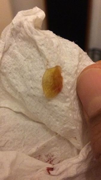 Cyst on head extracted- pics