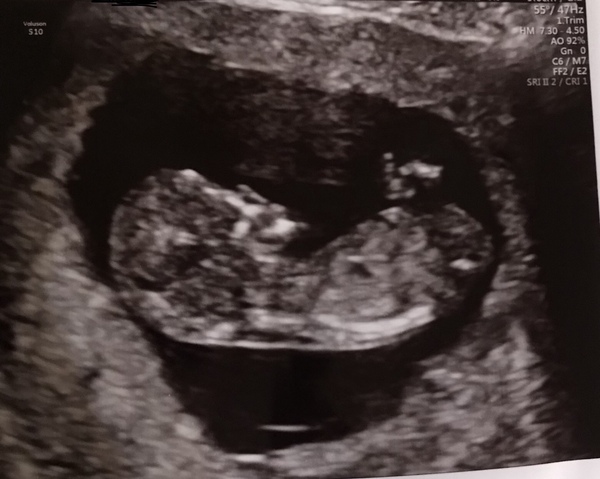 Sex guesses before scan tonight