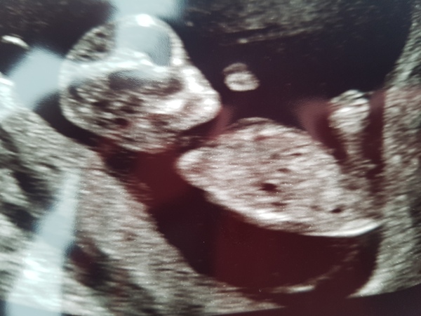 Baby due late August 2018