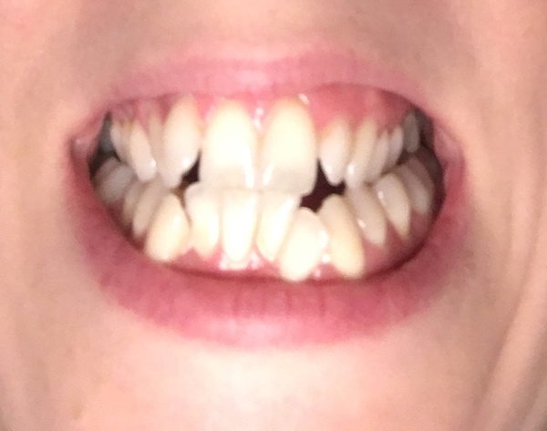To get braces? any dentists advise? (Photo attached)