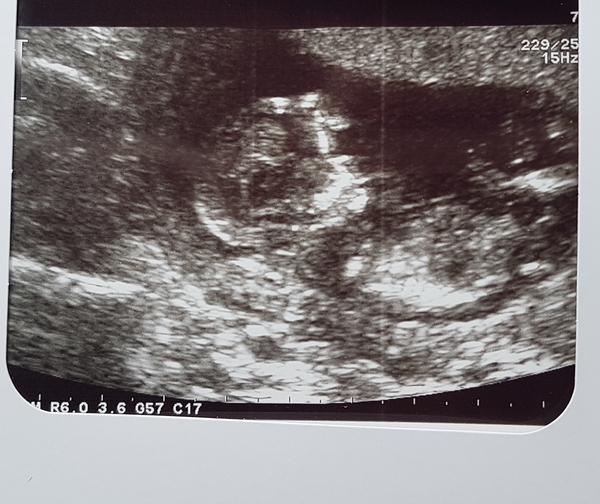 September 2018 #4: 12 weeks scans and bumps appearing!