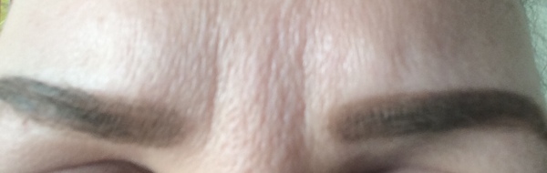 Deep wrinkles at aged 32- help!