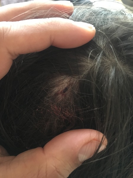 Cyst on head extracted- pics
