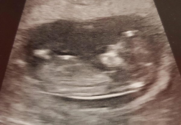 September 2018: #3! Early scans and booking in... it's all getting very real!