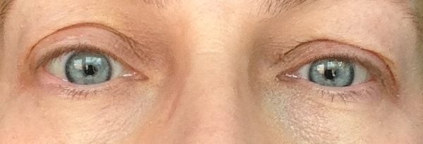Hooded eyes, what are the options?
