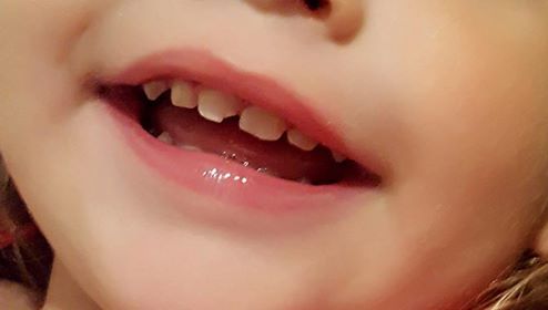 Dental Help Please re impact of chipped toddler tooth