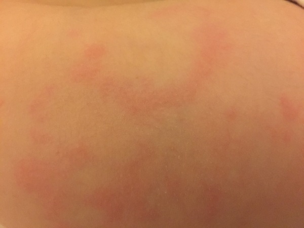 Any idea what sort of rash this is??
