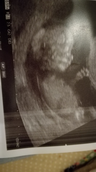 September 2018 #4: 12 weeks scans and bumps appearing!