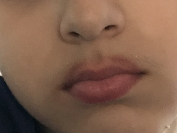 Inflamed red lip (pic inc)