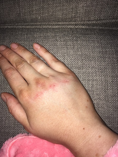 Injured hand