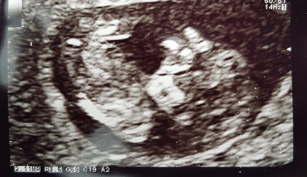 September 2018: #3! Early scans and booking in... it's all getting very real!