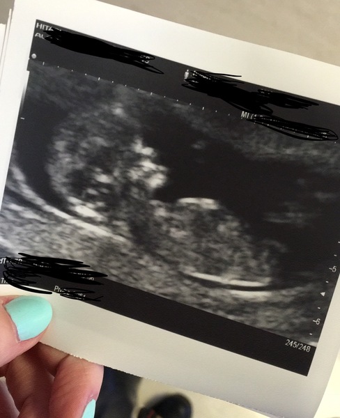 early gender scan this afternoon, any nub guesses?!