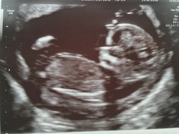 September 2018 #4: 12 weeks scans and bumps appearing!