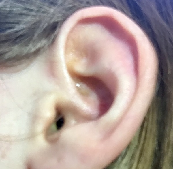AIBU for asking for emergency GP appointment for suspected ear infection?