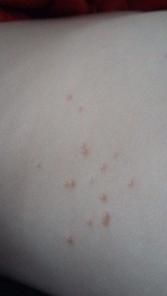 Molluscum contagiosum - is it at the end?
