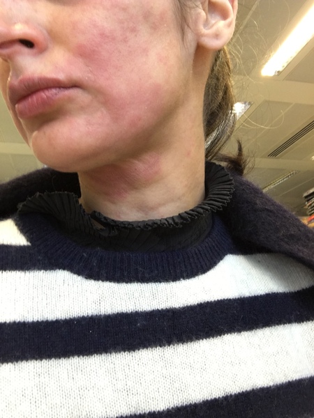 Please help me diagnose this rash on face - pic attached